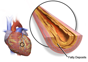 Heart Disease – An Overview