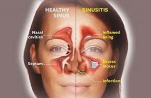 Sinusitis